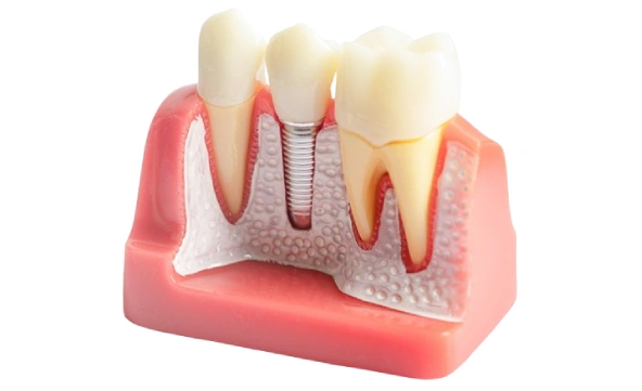 Implant Placement Surgery